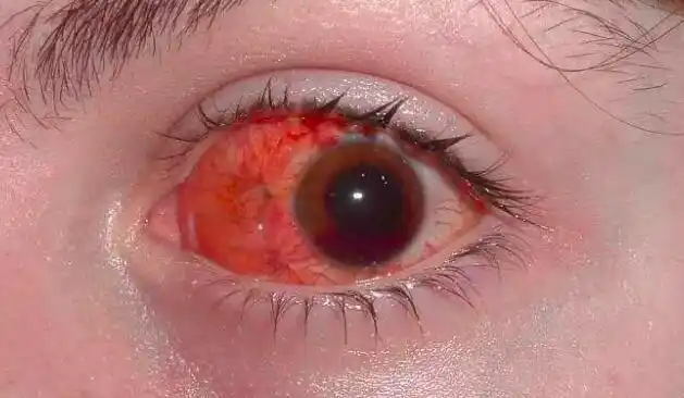 眼睛充血的情况,是眼白的地区泛红.