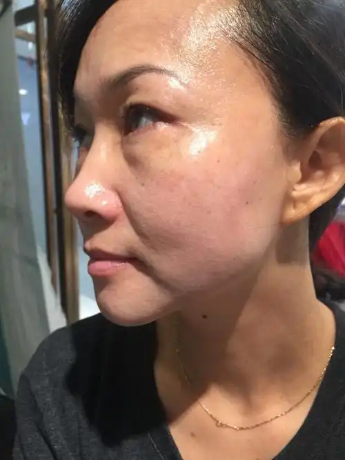 脸上本来松松垮垮的,现在精致了很多,皮肤更有弹性一_圈子-新氧美容