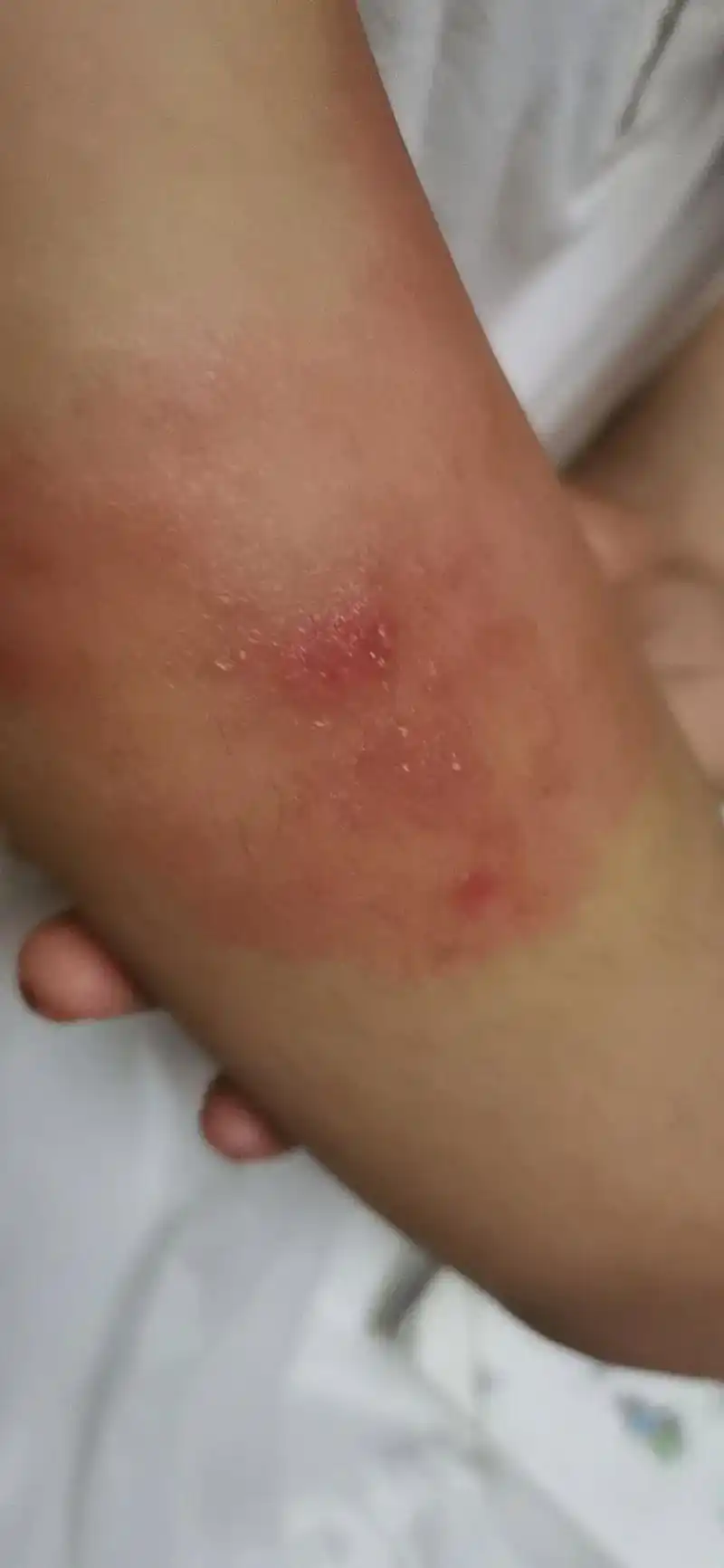 带孩子的家长注意点儿孩子身上的不明生物吧,蜱虫,一种以前从没 - 抖