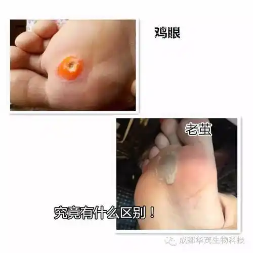 鸡眼怎么治都治不好,很有可能不是鸡眼,而是这种病