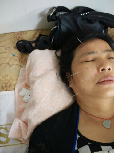 【原创】刘西林针治顽固面瘫