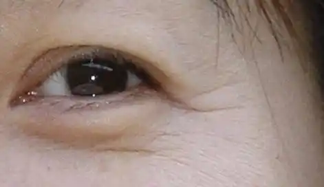 眼部皮肤松弛小偏方