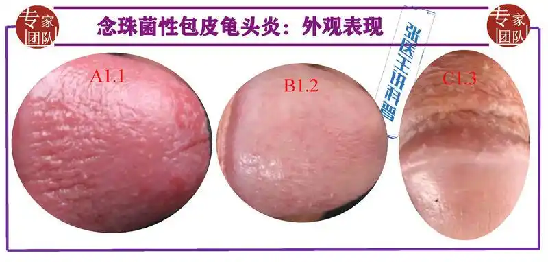 包皮龟头炎哪家医院看的好,治疗包皮龟头炎哪个医生好,包皮龟头炎推荐