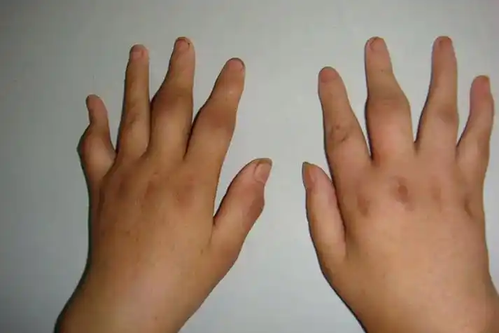 手指滑膜炎发病时,滑膜充血滑囊积液,有时关节见微红或不红漫肿,可致