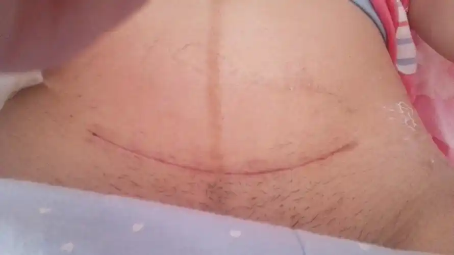 刀口为什么会增生 刀口增生怎么引起的