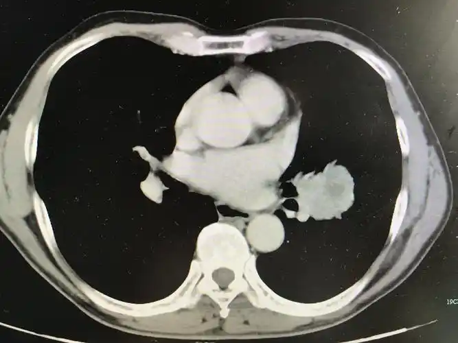 成功将中央型巨大肺癌切除并保留了肺功能