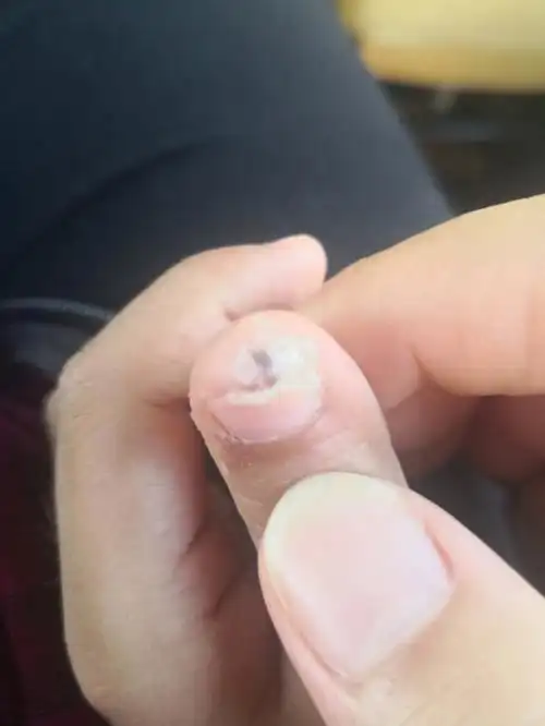 甲周疣治第六天打卡附几张去乌拉盖草原的照片