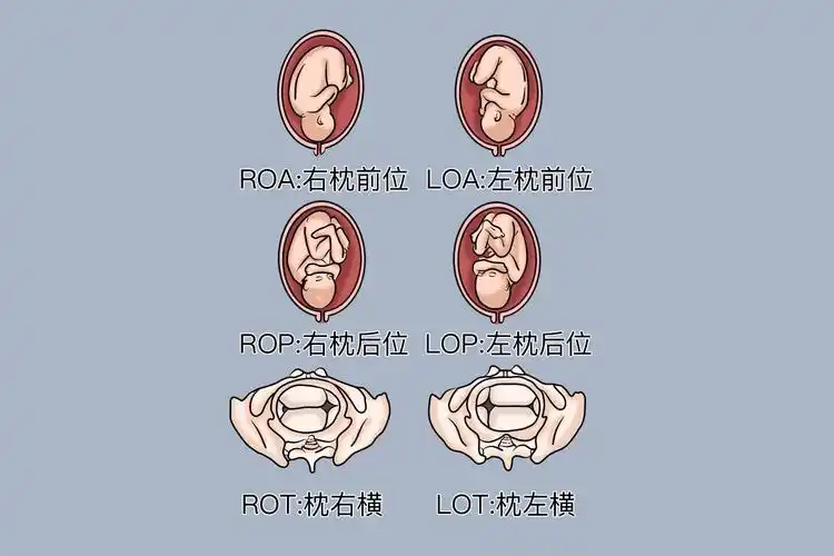 32周头位的胎儿姿势图分娩机制32周头位的胎儿枕部