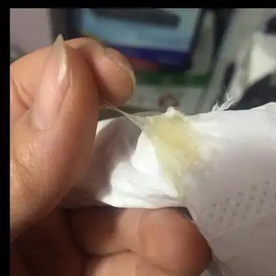 排出的异物像浓鼻涕一样黏 这是正在排卵?