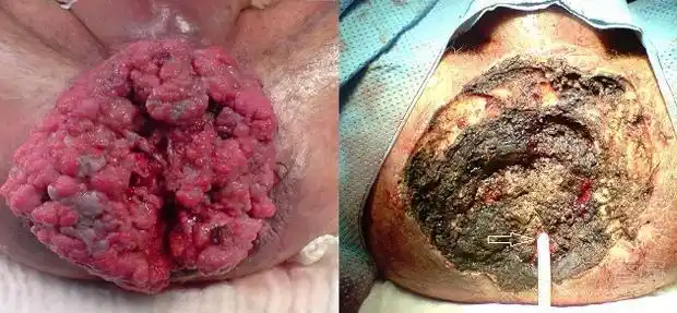 hpv 6和11型相关型的 巨大尖锐湿疣即便不是艾滋病患者也可以发生.