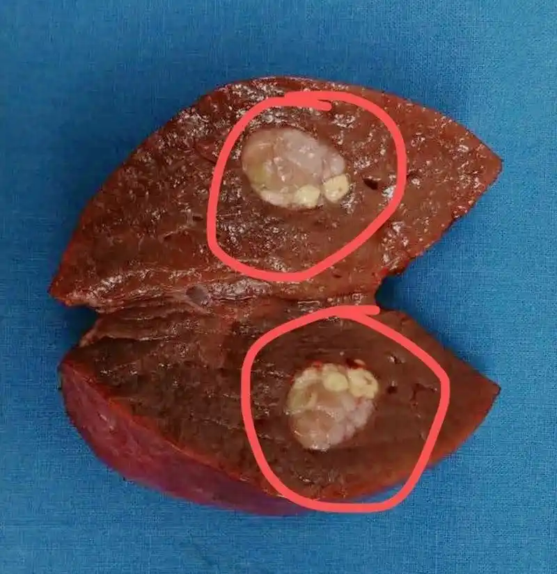 这是一位肝细胞癌病人,33岁男性,是乙肝小三阳患者,前年开始抗病毒