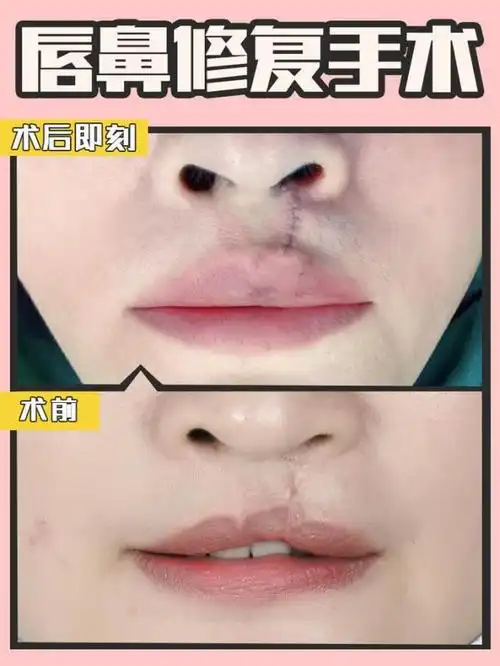 拥有了正常的唇鼻形态,相信这位求美者能恢复自信,从此之后生活工作