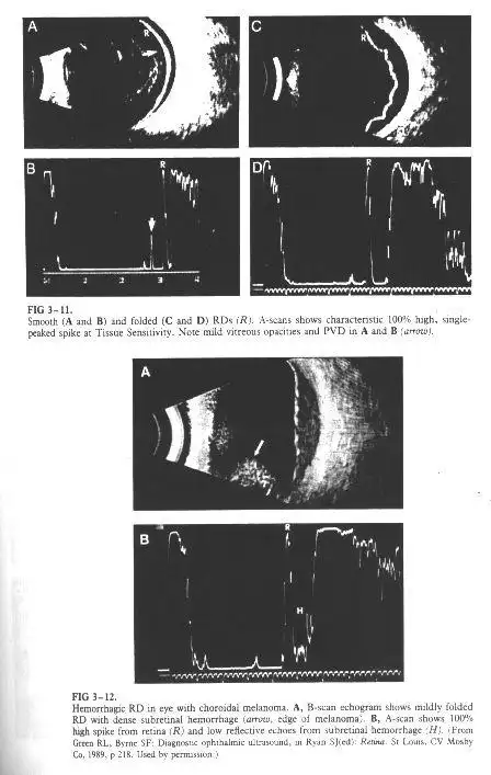 玻璃体后脱离网脱和脉络膜脱离的超声检查鉴别