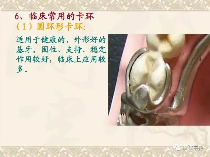 局部义齿卡环