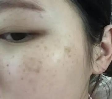 原来长斑要忌口3样食物,难怪斑点越吃越多_皮肤_解决方案_感光