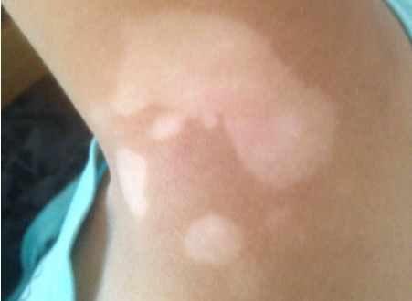 汗斑图片大全48