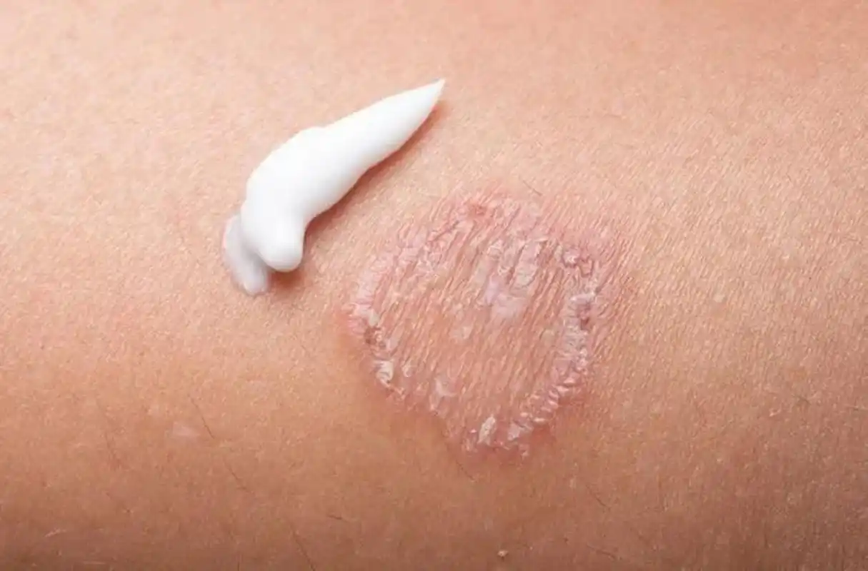 癣和皮炎湿疹经常容易搞混, 一个典型的症状有助于区分什么是癣. 图片