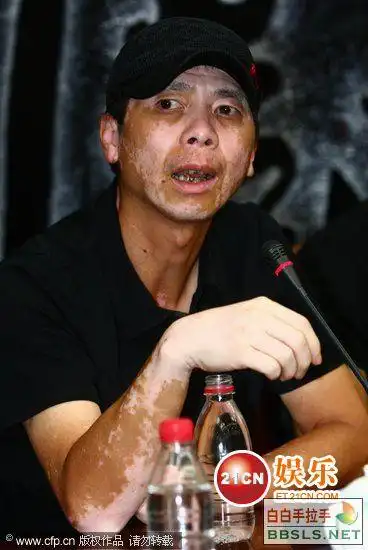 冯小刚白癜风日益严重
