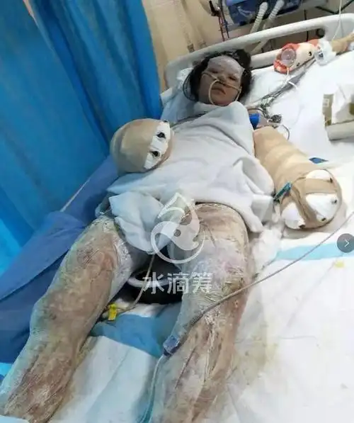 凌晨4点萧县一家四口重度烧伤最小的才6岁