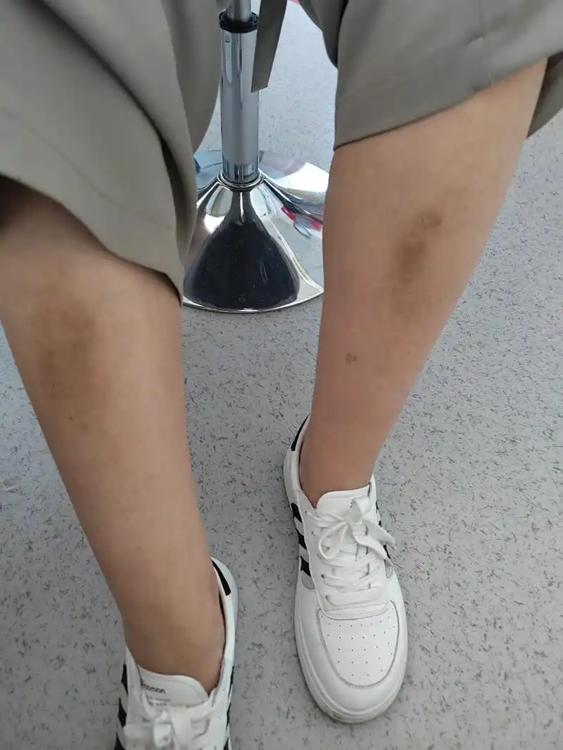 小腿胫前的色素沉着过度和皮肤粗糙症状.考虑淤积性皮炎可能.