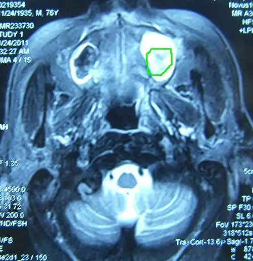 典型病例分享26-上颌窦癌2伴骨侵犯调强放疗后病灶基本消失 - 好大夫