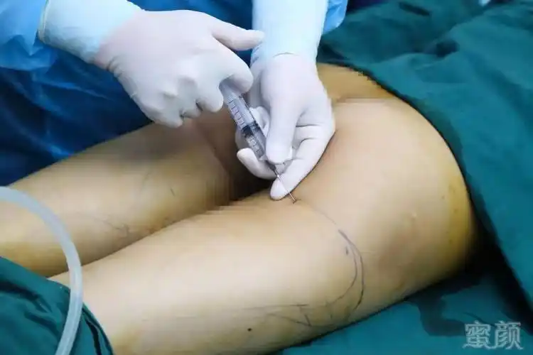 手术现场!自体脂肪填充如何破"飞机场"尴尬!