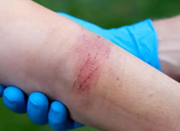 浅表性疤痕是在疤痕形成时的一个纤维血管增生期出现.