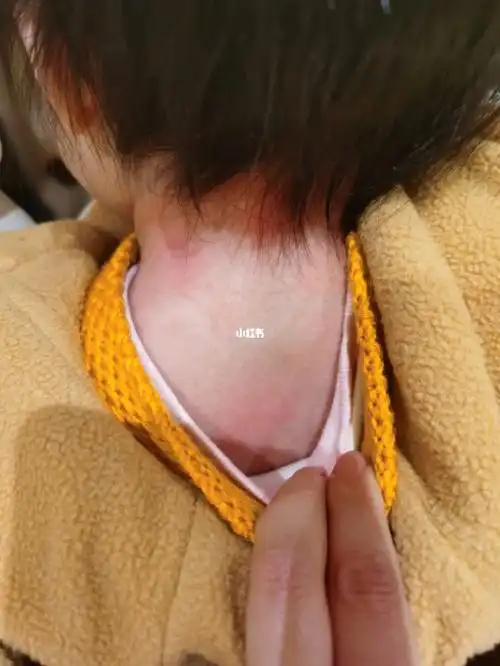 宝宝一岁一个月,由于各种原因,麻腮风推迟没打.