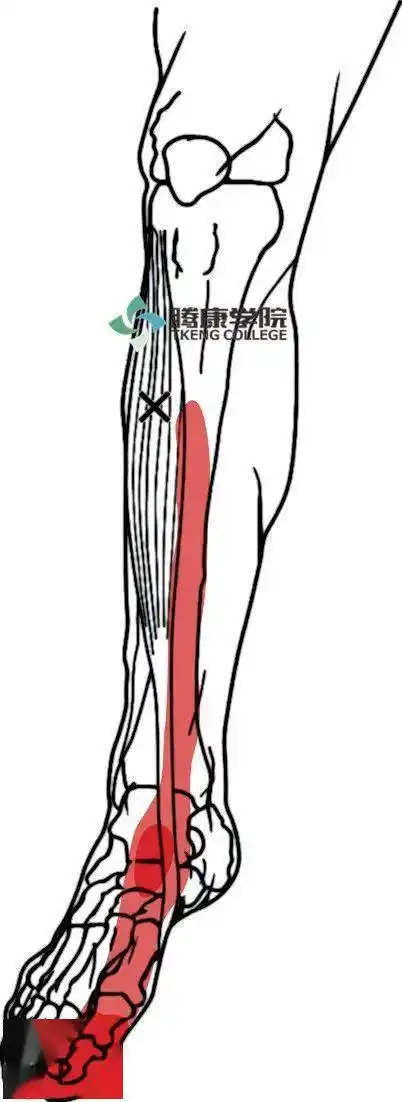 肌肉疗法|胫骨前肌综合征