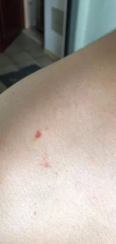 请各位大神辨别一下我男朋友这是勒痕还是吻痕,在线等,挺急的