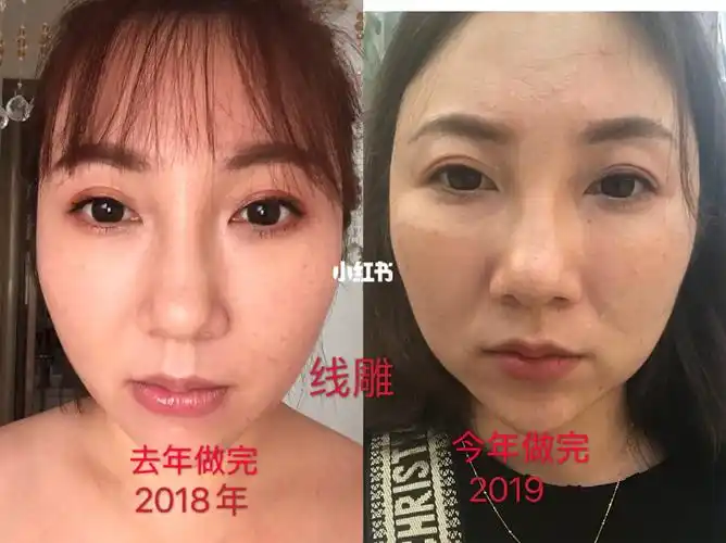 拉皮手术第十二天_消肿_眼部_摄像头_疼痛感_提拉紧致_美颜_溶脂_拉皮