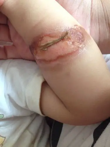 小孩一岁半开水烫伤从现在已有7天,求专家帮助!