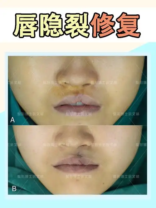 案例分析一个唇隐裂的小姐姐手术后唇部恢复正常