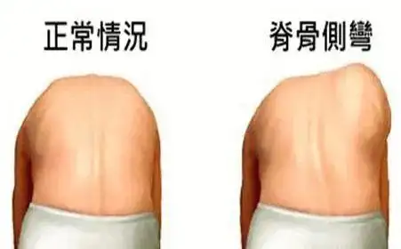 a:脊柱侧弯分胸椎侧弯和腰椎侧弯.