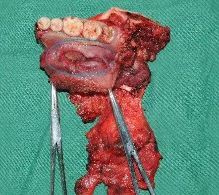 图2 口腔癌累及下颌骨图3 a下颌骨肿瘤经口腔内切除后应用髂骨瓣经