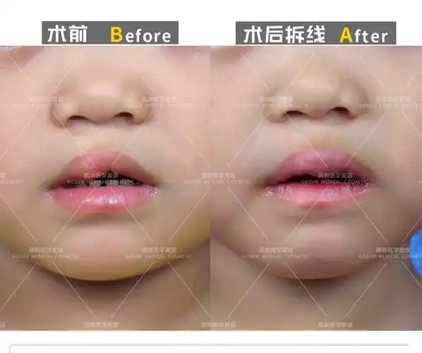 像这位小女孩的问题就是唇裂术后唇红局部肥大,只需要进行红唇修复,让