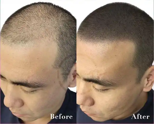 要秃顶了怎么办不伤头发的3d纹发技术精密操作