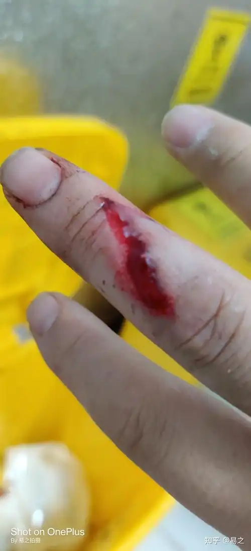 手被刀切了个深口子应该怎么处理