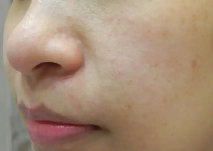 宁波毛孔粗大如何预防和治疗