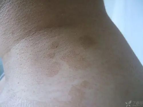 【请教】颈胸腋部卡色斑,这么治疗