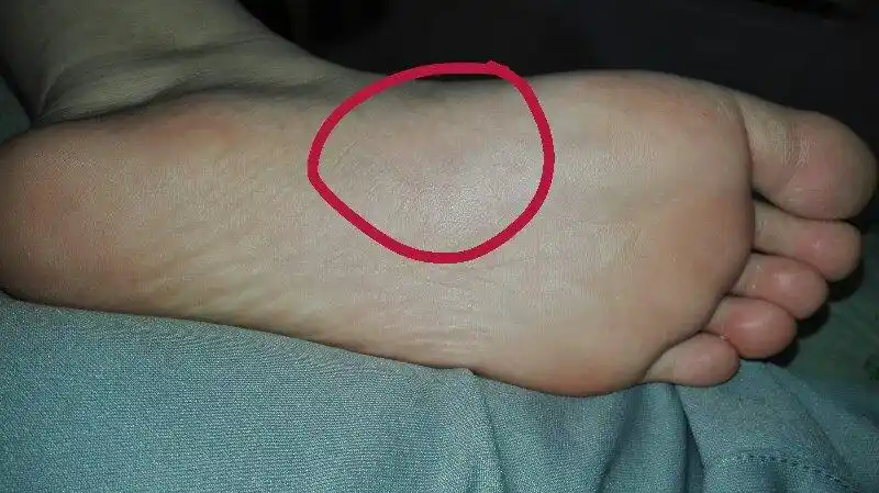 脚心前侧走路时一弯脚掌就疼,有种针刺,又有种撕裂的感觉