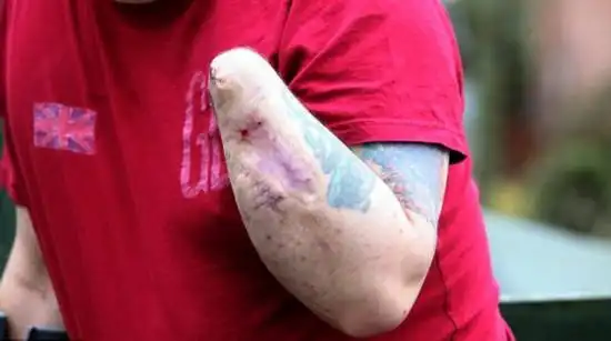 英男子车祸后神经受损 痛疼难忍自行截肢