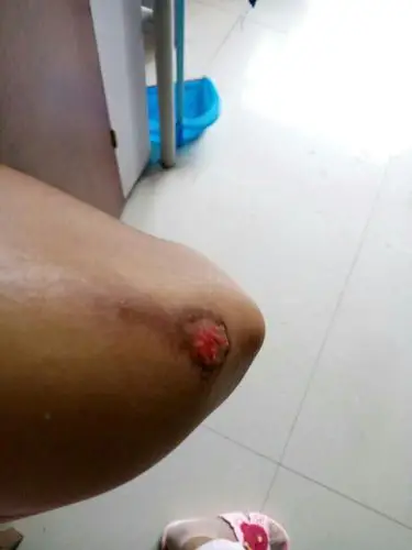 胳膊擦破皮了,,多久擦一次碘酒