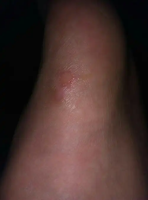 我脚上磨掉一层皮 现在好疼 鞋子穿不上 但我没有别的鞋子 只有运动鞋