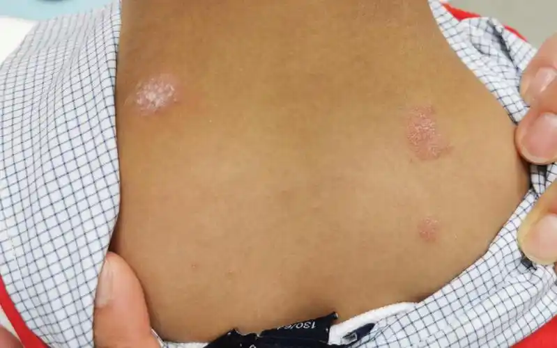 斑块状银屑病:约占70%,表现为界限清楚的红色(或粉红色)斑块,覆有较厚