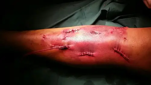 手术结束,皮肤切口.