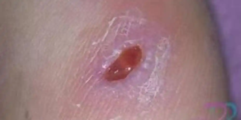 淋病的治疗与图片