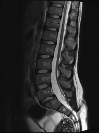 宝宝屁股上的小坑,可能会引起瘫痪