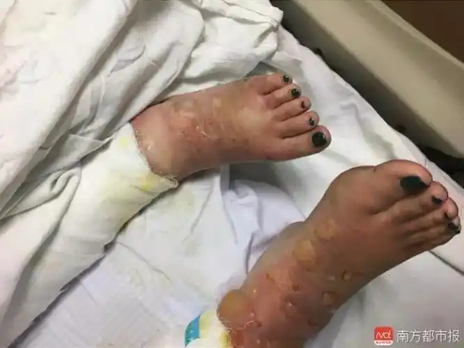 扩散帮帮她!24岁女孩重度烧伤病情危重,母亲赴粤途中车祸身亡