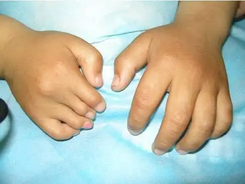 多指畸形